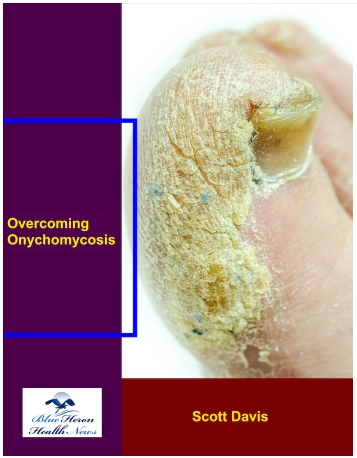 Overcoming Onychomycosis Reviews